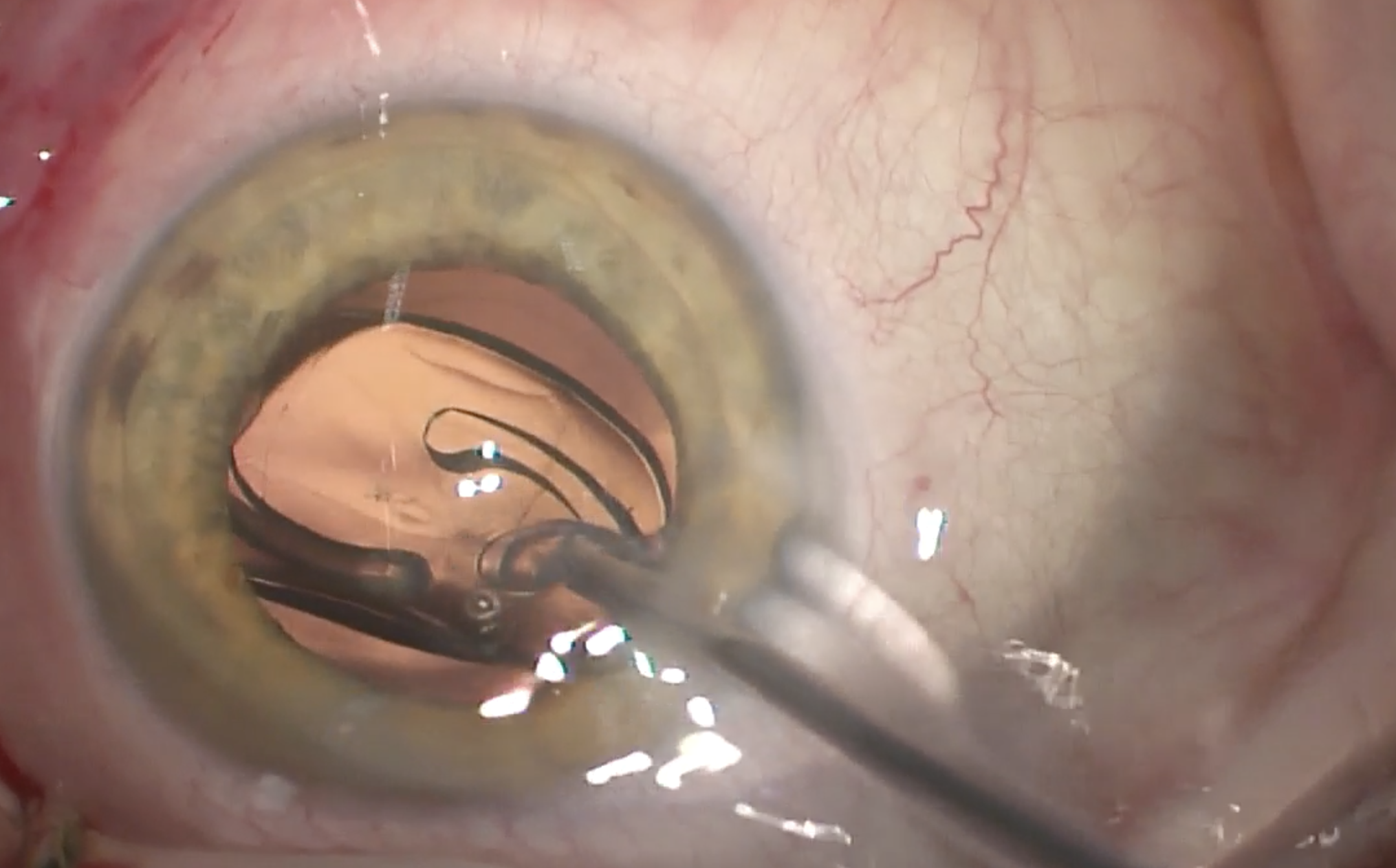 Image of intraocular lens implant